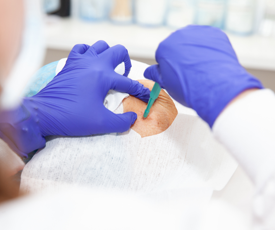 biopsie-sein-procedure-chirurgicale-locale