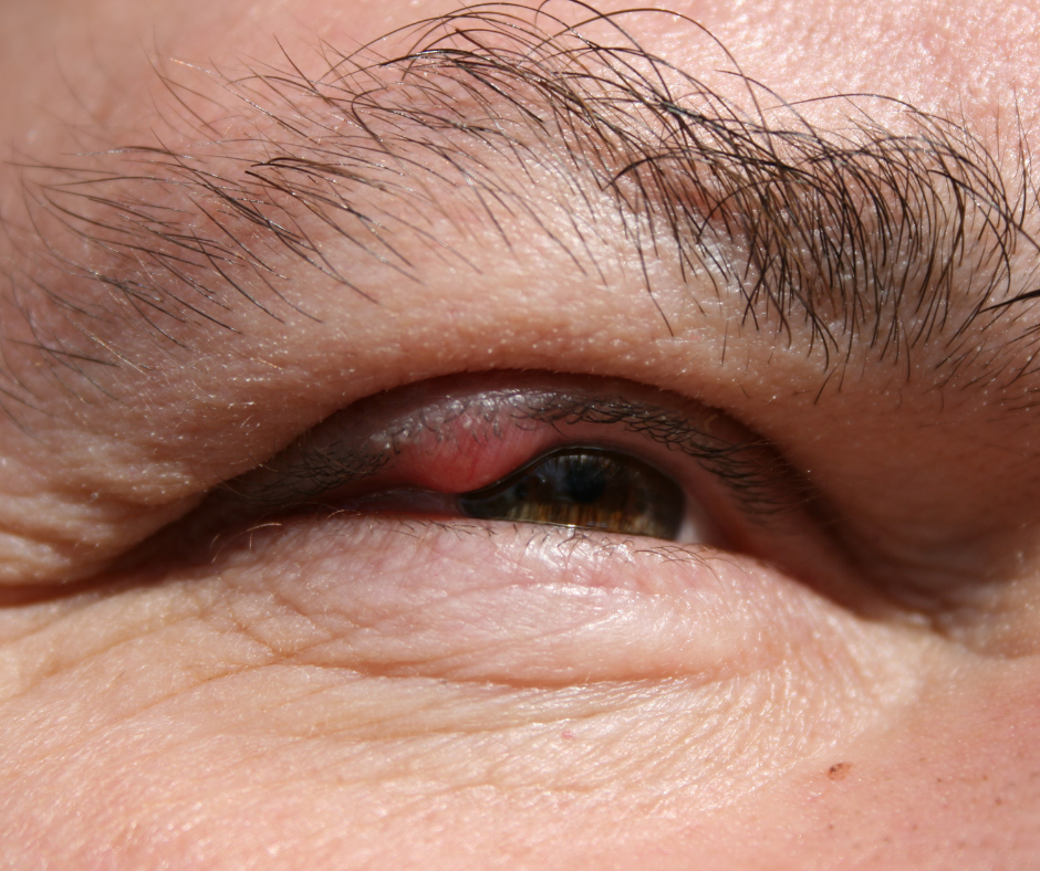 chalazion-oeil