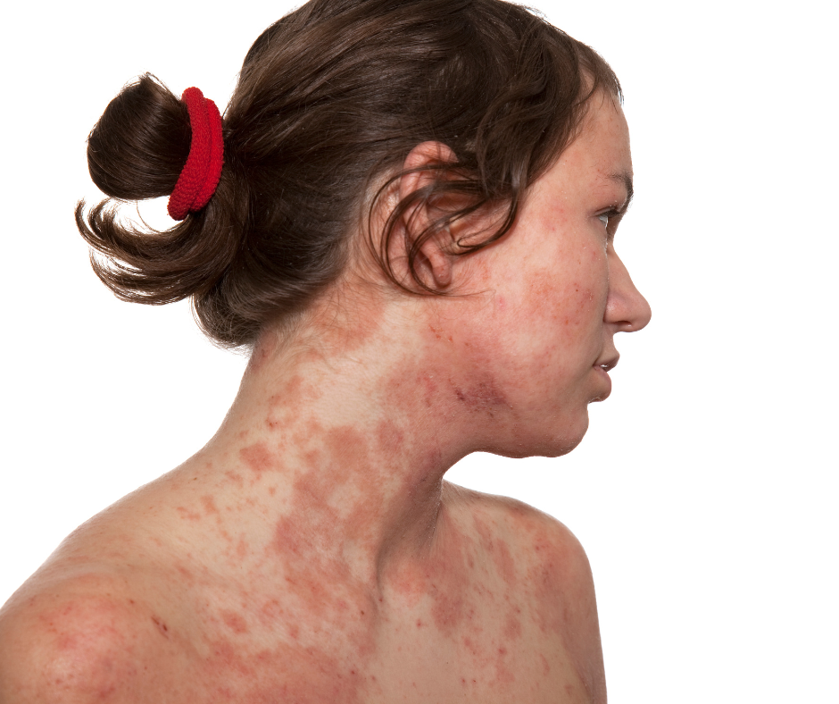 eczema-visage-chez-une-femme