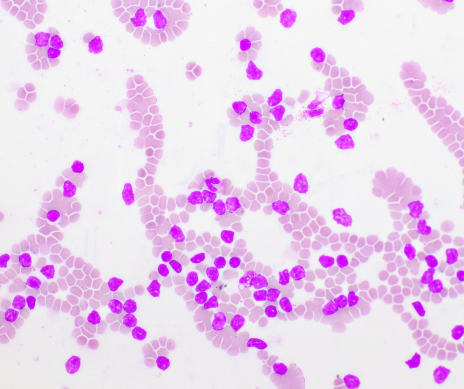 leucémie-lymphoide
