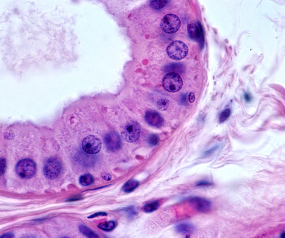 leucémie-lymphoide
