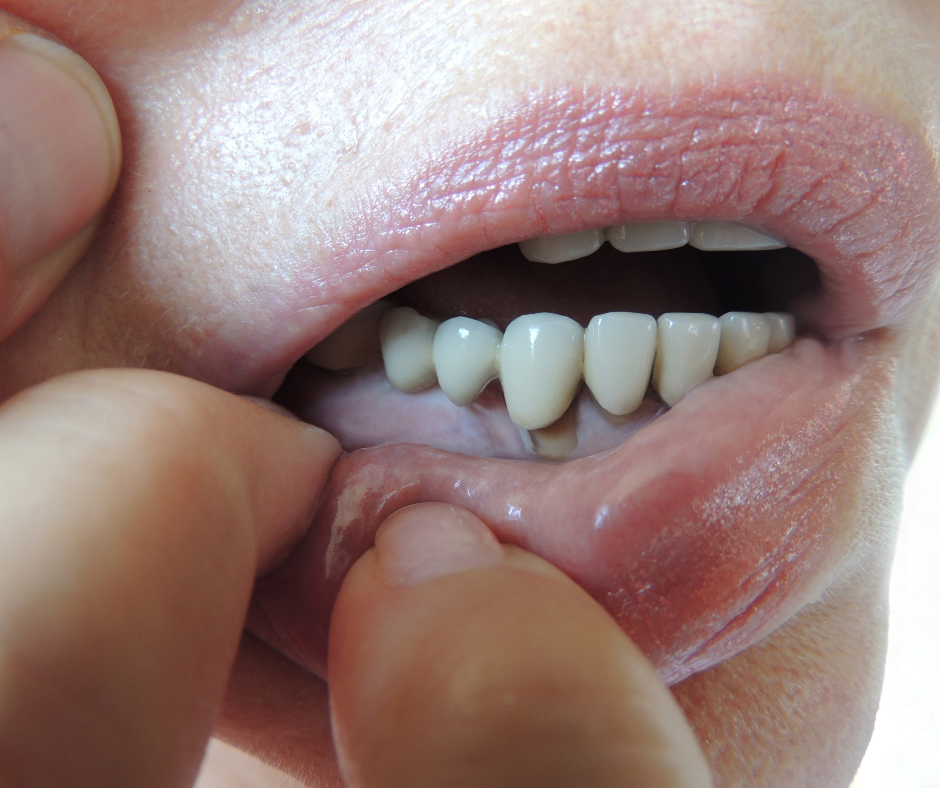 parodontite-et-cancer-buccal