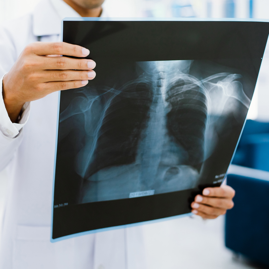 embolie-pulmonaire-signe-radio-thoracique-analysee-par-medecin-en-consultation