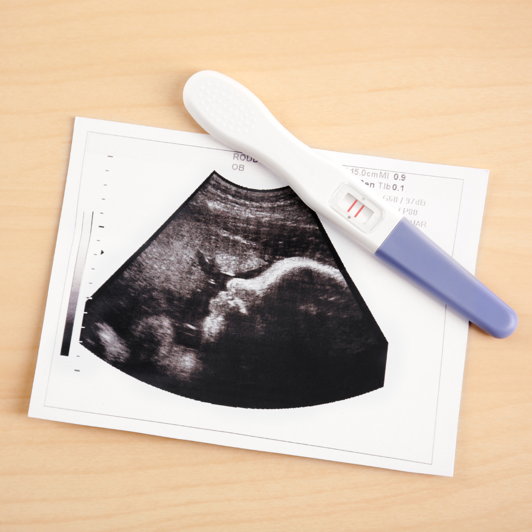 test-grossesse-positif-échographie-SOPK-grossesse-suivi-gynécologue-martinique