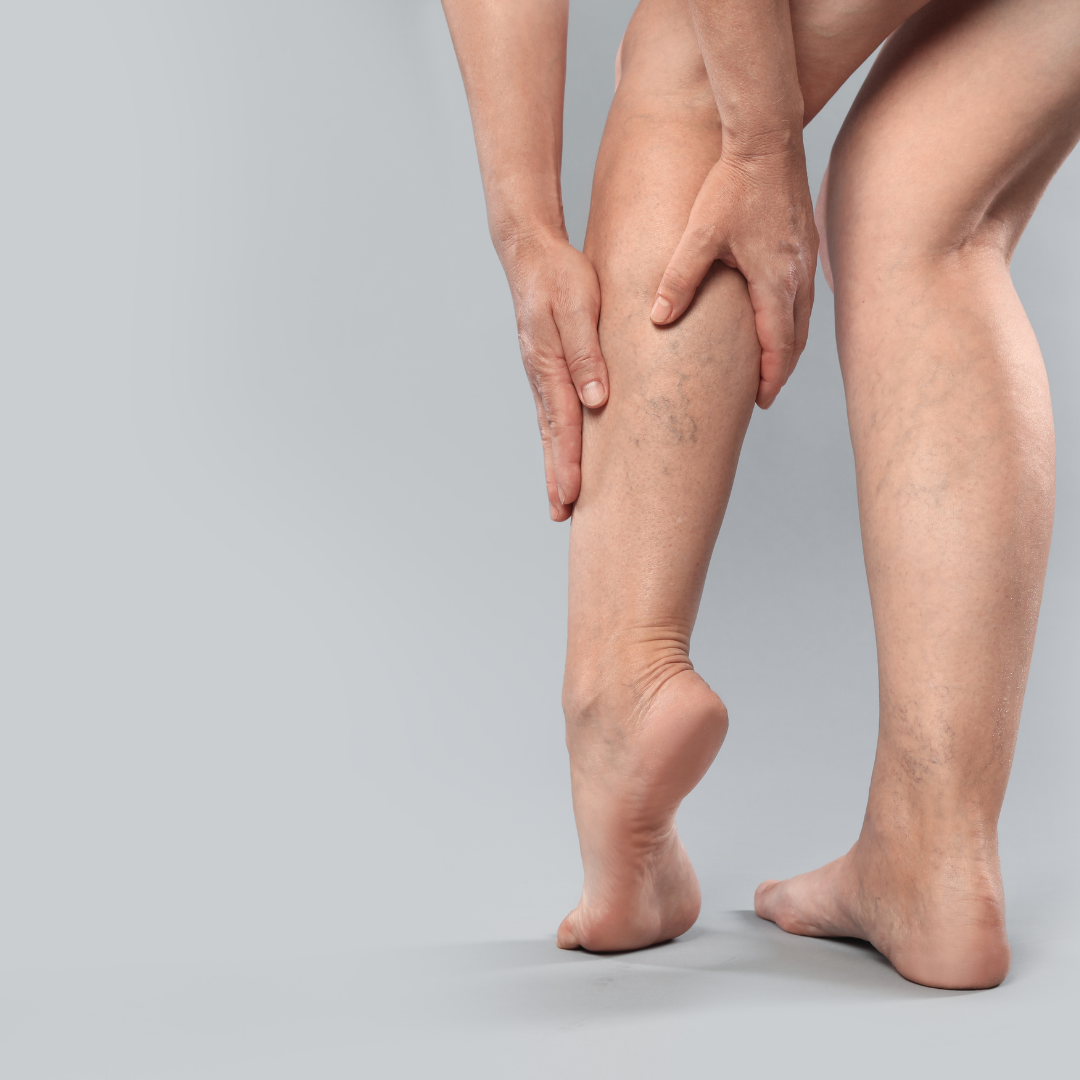 Traitement naturel des varices aux jambes : solutions et astuces pour soulager