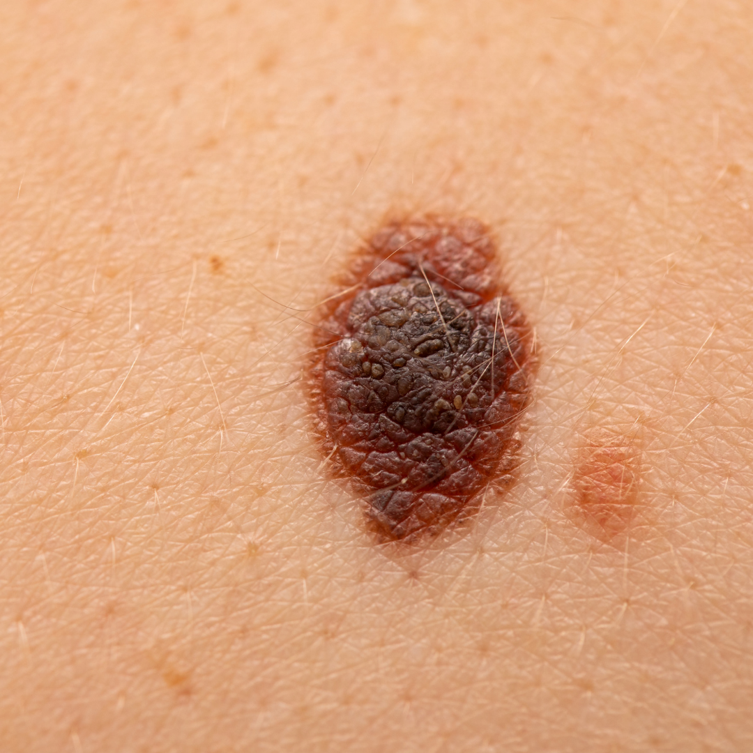 Mélanome : diagnostic, biopsie et traitements selon le stade