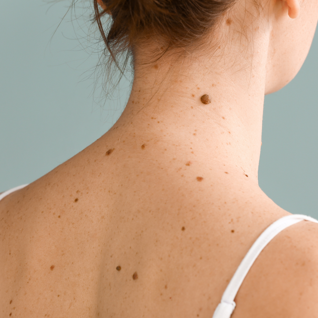 Mélanome : signes cliniques à reconnaître sur la peau avec méthode ABCDE