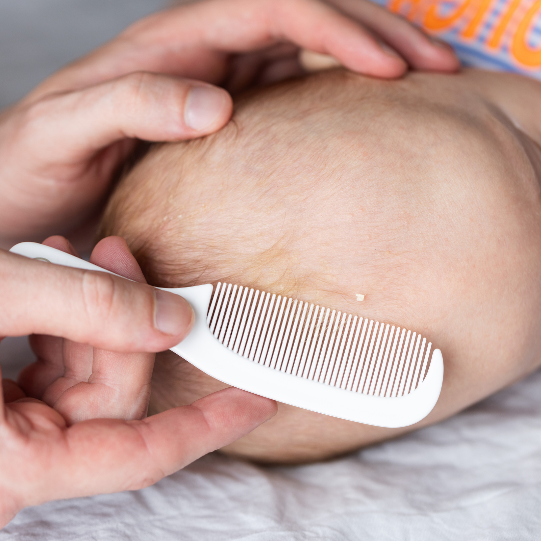 croûte-de-lait-bébé-traitement