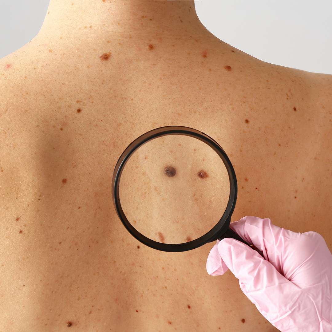Mélanome : comment le reconnaître à temps sur votre peau